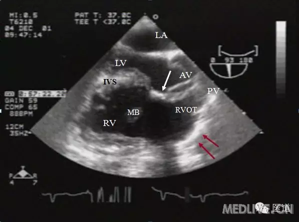 病例法洛四联症术后右心室流出道梗阻1例