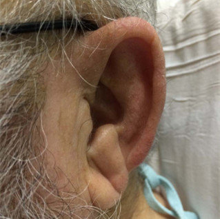 【病例】frank`s征:冠状动脉疾病的预测因素