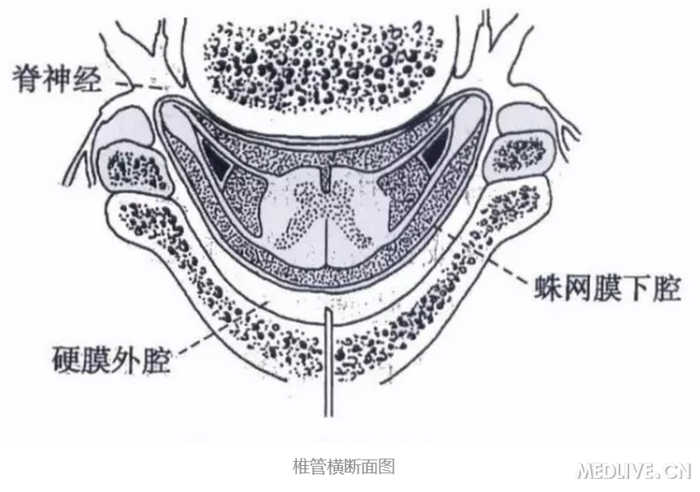 硬膜外麻醉不慎穿破硬膜怎么办
