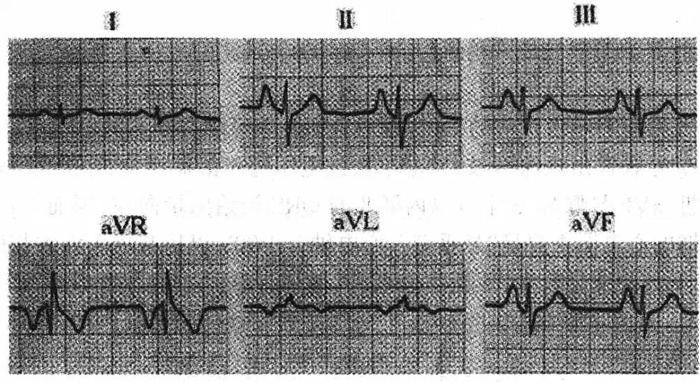 右心房肥大心电图表现2,右房肥大:右房除极时间延长,往往与稍后除极左