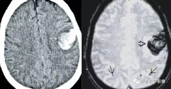 七,早产儿脑出血多见于早产儿,出血部位多位于脑室旁室管膜下,尾状核