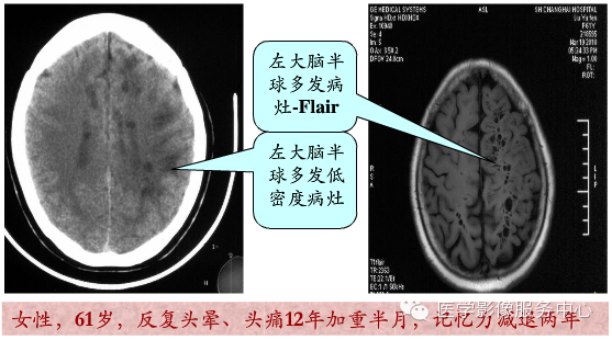 图文详解血管周围间隙与腔隙性脑梗塞如何区别