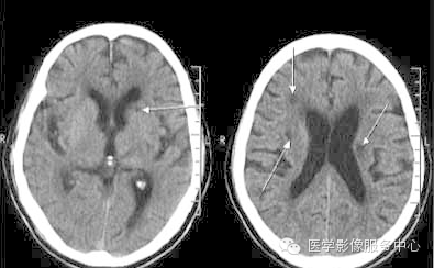 5厘米.这种梗死多发生在大脑深部的基底节区以及脑干等部位.
