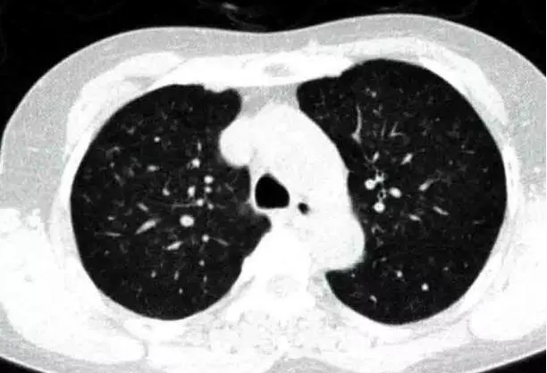 学习:呼吸性细支气管炎一例