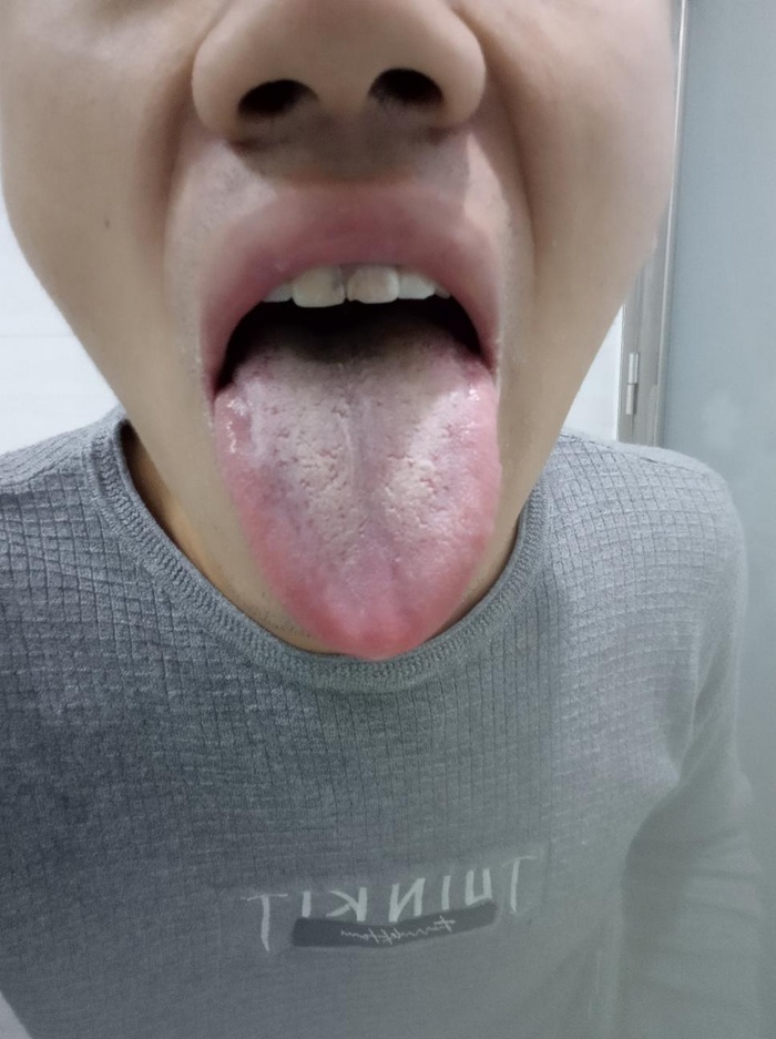 舌头上有白斑图片图片